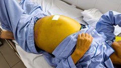 Phát hiện viêm gan B muộn, 2 bệnh nhân gặp bệnh lý nguy hiểm về gan