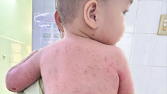 Bé 2 tuổi bỏng toàn thân, phải ghép da từ mẹ ruột