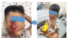 Đang chơi đùa, bé trai bị chó cắn rách má phải