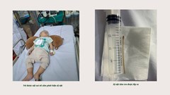 Lào Cai: Kịp thời nội soi gắp tăm tre trong ống tiêu hóa của bệnh nhi 7 tháng tuổi