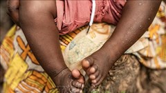 Gambia tuyên bố bùng phát dịch bệnh đậu mùa khỉ