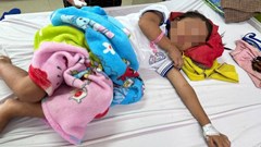 Cháu bé 7 tuổi nhập viện với 200 vết ong đốt gây bội nhiễm, tổn thương giác mạc