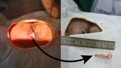 Bị gà trống tấn công, người đàn ông suýt mất mắt vì cựa gà đâm sâu