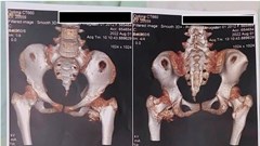 TP.HCM: Phát hiện hội chứng “người hóa đá” thể cực hiếm ở bệnh nhi 12 tuổi 