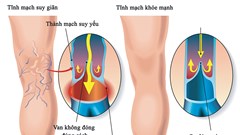 Bệnh suy tĩnh mạch mạn tính nguy hiểm thế nào?