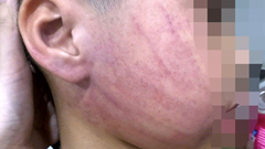 Công an vào cuộc điều tra vụ bé 4 tuổi nghi bị bạo hành tại trường mầm non ở Hà Nội