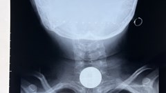 Gắp đồng xu bằng kim loại nằm ở thực quản của bé gái 7 tuổi