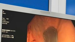 Gắp thành công nắp lon nước ngọt do bé trai 11 tuổi nuốt phải