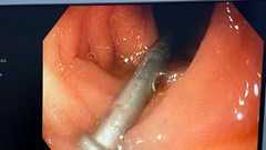 Gắp đinh sắt trong dạ dày bé trai