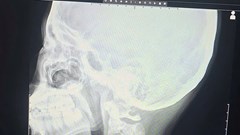 Nội soi gắp thành công mảnh xương gà dài 3cm cho bé trai 12 tuổi