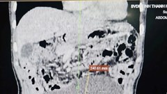 Cắt bỏ khối u buồng trứng gần 3 kg, cứu nữ bệnh nhân đau đớn suốt nhiều năm