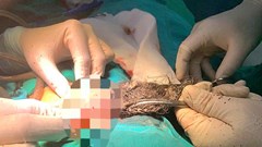 Búi tóc dài gần 20cm trong dạ dày bé trai 46 tháng tuổi