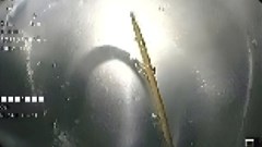 Cụ ông 71 tuổi thủng tá tràng vì ngậm tăm khi ngủ