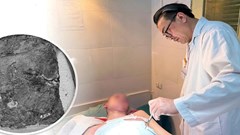 Nam sinh nhiễm trùng nặng do điều trị bỏng bằng thuốc nam tại nhà