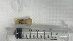 Ho khó thở, cụ ông 81 tuổi được phát hiện răng rơi vào phế quản