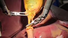 Robot trở thành bác sĩ phẫu thuật lành nghề