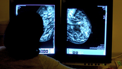 Ung thư vú toàn cầu có thể vượt 3,5 triệu ca mỗi năm vào 2050