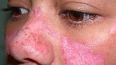 Cô gái Huế đột ngột qua đời trước ngày cưới nửa tháng do mắc bệnh lupus ban đỏ: Cảnh báo 1 nhóm phụ nữ nguy cơ cao mắc bệnh
