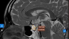 Nam bệnh nhân bất ngờ phát hiện u tuyến yên từ những dấu hiệu nhiều người Việt gặp phải