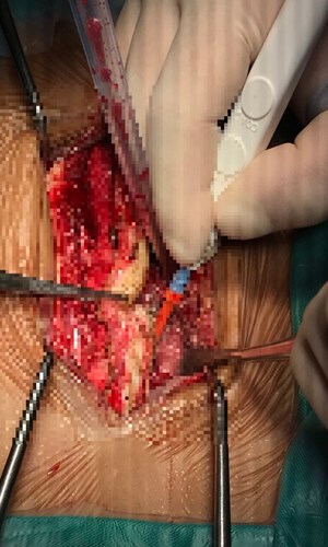 Mâu thuẫn trong đám cỗ, một thanh niên bị đâm xuyên tủy sống bằng que xiên thịt - Anh 2