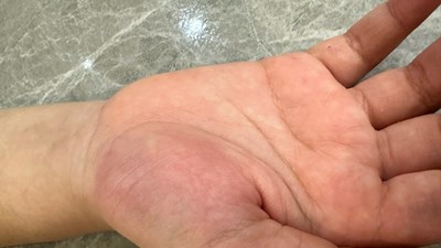 Bệnh viện chứng nhận thương tích của học sinh lớp 4 bị cô giáo đánh vào tay