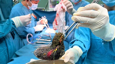 Phẫu thuật thành công ca “Hội chứng Rapunzel” hiếm gặp tại Quảng Ngãi