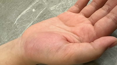 Xác minh vụ việc cô giáo đánh tay học sinh lớp 4 gây chấn thương