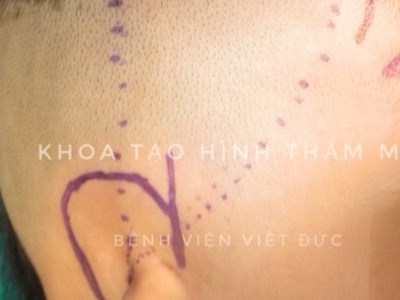 Để trẻ đến trường không bị mặc cảm vì vành tai dị tật