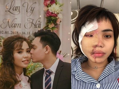 Vụ cựu thiếu úy  công an tạt axit vợ chưa cưới: Quá tàn độc và coi thường pháp luật