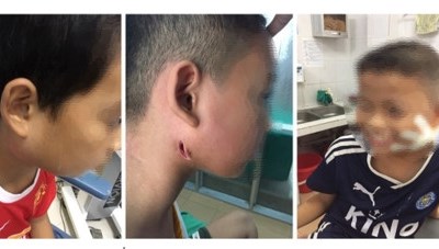 Nghệ An: 3 bệnh nhi mắc bệnh nhiễm "vi khuẩn ăn thịt người", 1 cháu đã được xuất viện