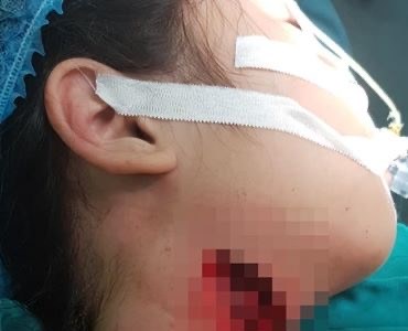 Trẻ liên tiếp nhập viện do tai nạn sinh hoạt