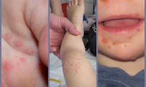 Hà Nội: Trẻ mắc tay chân miệng tăng nhanh