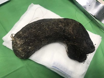 Phẫu thuật lấy 1kg búi tóc trong dạ dày bé gái ở Nghệ An