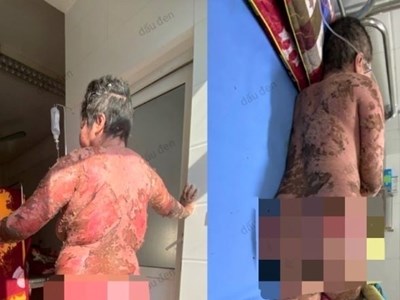 Suýt mất mạng vì tự ý sử dụng thuốc nam không rõ nguồn gốc