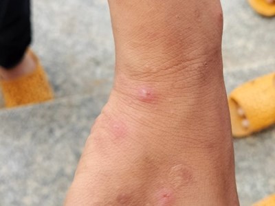 Bệnh ghẻ ở Quảng Ngãi bước đầu có thuyên giảm