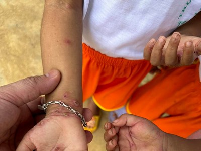 Quảng Nam: Chủ động ngăn chặn dịch bệnh ghẻ bùng phát tại các huyện miền núi