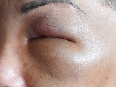 Bị lừa tiêm filler giá rẻ, bệnh nhân bị tai biến và mất sạch tài sản