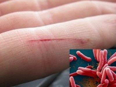 Quảng Nam chỉ đạo tăng cường  công tác chẩn đoán và điều trị bệnh Whitmore