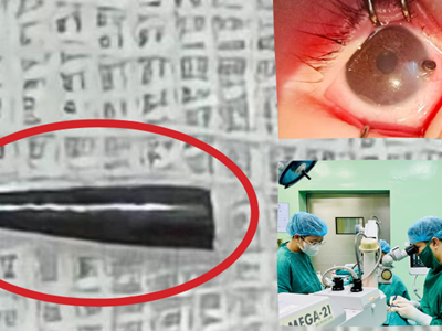 Phẫu thuật thành công bé trai bị ruột bút chì xuyên thủng nhãn cầu