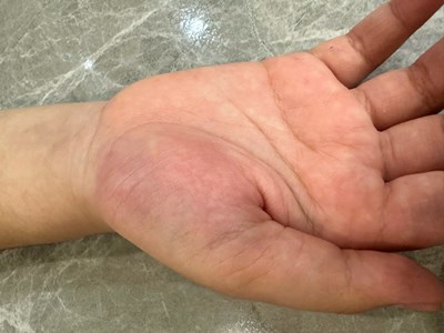 Bệnh viện chứng nhận thương tích của học sinh lớp 4 bị cô giáo đánh vào tay