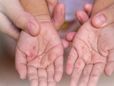 Bộ Y tế cảnh báo nguy cơ bùng phát dịch tay chân miệng và sốt xuất huyết