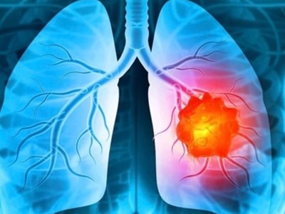 AI trở thành “mắt thần” giúp tầm soát ung thư phổi 