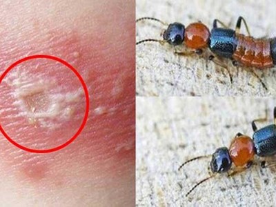 5 bước xử lý đúng cách khi tiếp xúc với kiến 3 khoang