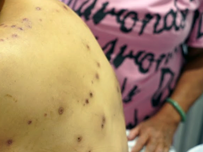 Cứu sống người phụ nữ bị ong vò vẽ đốt 70 vết, gây sóc phản vệ