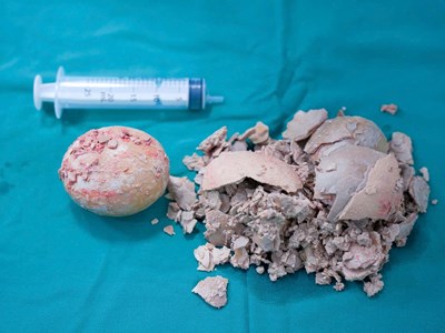 Bệnh viện Hùng Vương Gia Lai phẫu thuật thành công sỏi bàng quang “khổng lồ” hơn 10cm