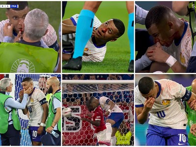 Mbappe bị gãy mũi, tình hình “không ổn“