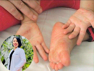 BS khoa Nhi cảnh báo dấu hiệu virus tấn công tế bào thần kinh, cha mẹ không được bỏ qua