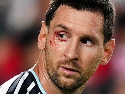 Messi rách mí mắt vì khuỷu tay Xhaka, vẫn chiến đấu đưa Argentina vào bán kết