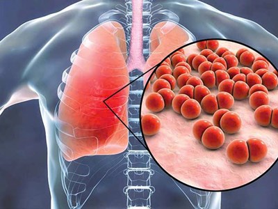 Những biến chứng nguy hiểm của cúm A nếu không phát hiện và điều trị kịp thời