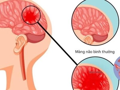 Bệnh não mô cầu xuất hiện trong trường học: Những dấu hiệu phụ huynh không thể bỏ qua